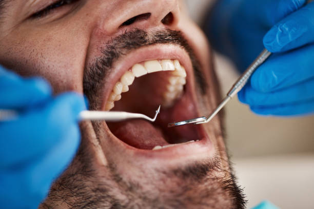 Best Emergency Dental Care for Broken or Chipped Teeth in Westhampton, NY