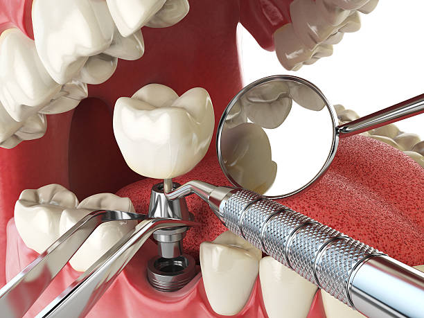 Best Emergency Treatment for Dental Infections or Abscesses in Westhampton, NY